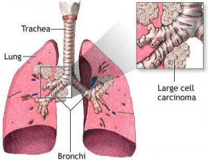 lung-cancer lung-cancer