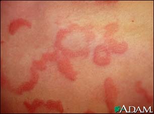 urticaria